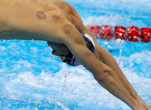 Cupping