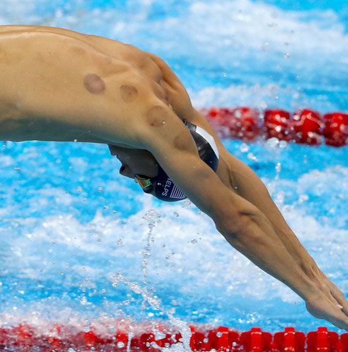Cupping